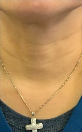 After xeomin, front view — a patient of Dr. George Ferzli, New York