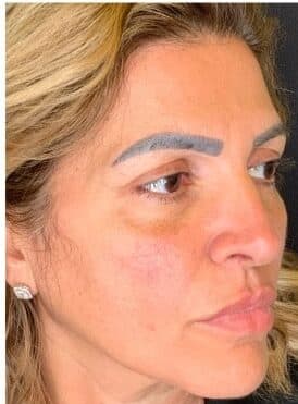 After blepharoplasty, right front oblique view — a patient of Dr. George Ferzli, New York