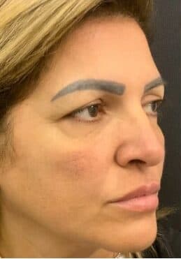 Before blepharoplasty, right front oblique view — a patient of Dr. George Ferzli, New York