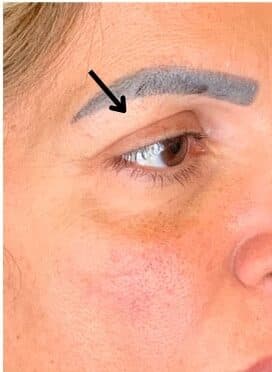 After blepharoplasty, right front oblique view — a patient of Dr. George Ferzli, New York