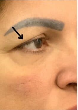 Before blepharoplasty, right front oblique view — a patient of Dr. George Ferzli, New York