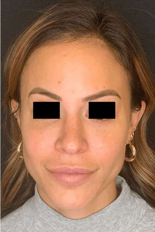 After botox / xeomin, front view — a patient of Dr. George Ferzli, New York