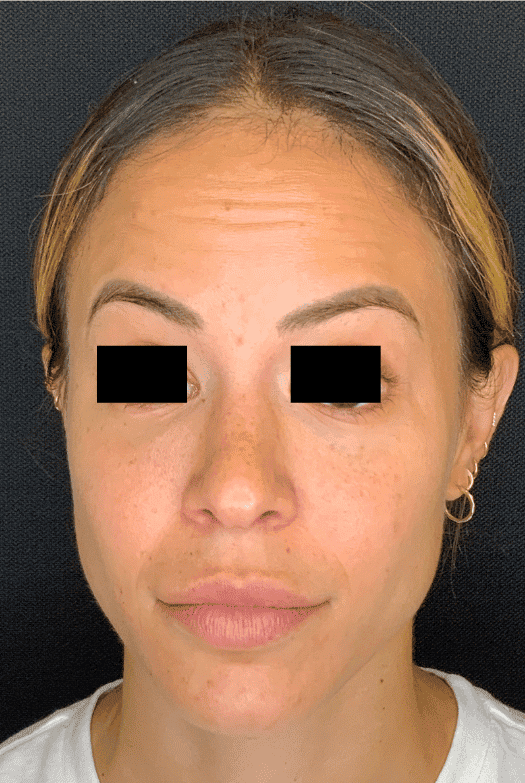 Before botox / xeomin, front view — a patient of Dr. George Ferzli, New York