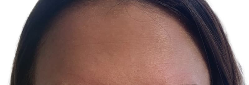 After botox / xeomin, other view — a patient of Dr. George Ferzli, New York