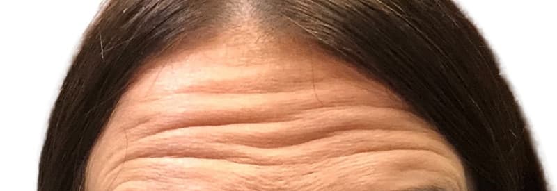 Before botox / xeomin, other view — a patient of Dr. George Ferzli, New York