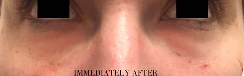 After restylane filler – under eye, other view — a patient of Dr. George Ferzli, New York