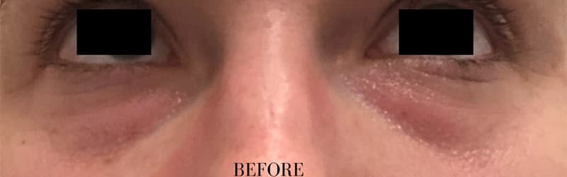 Before restylane filler – under eye, other view — a patient of Dr. George Ferzli, New York