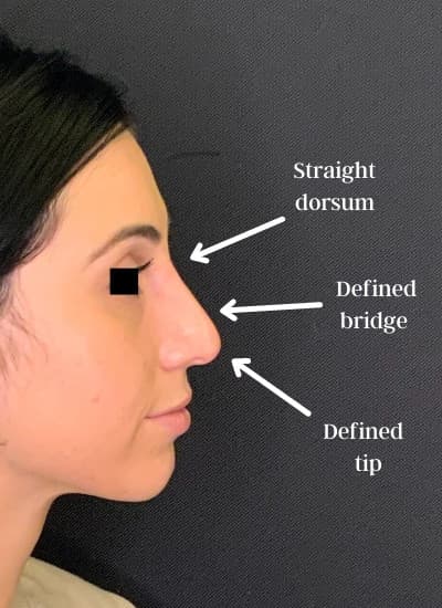 After restylane filler – liquid rhinoplasty, other view — a patient of Dr. George Ferzli, New York