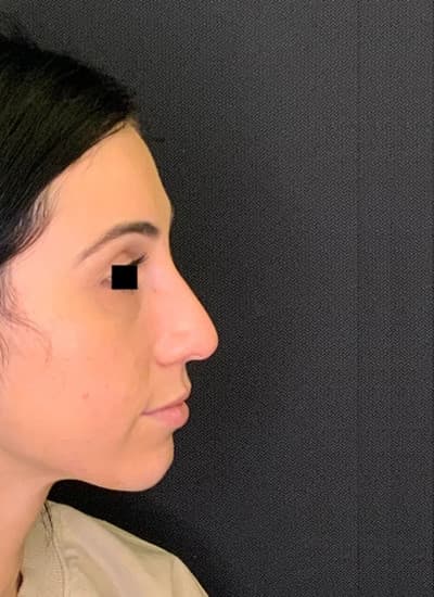 Before restylane filler – liquid rhinoplasty, other view — a patient of Dr. George Ferzli, New York