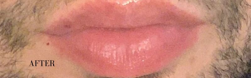After restylane filler – lips, other view — a patient of Dr. George Ferzli, New York