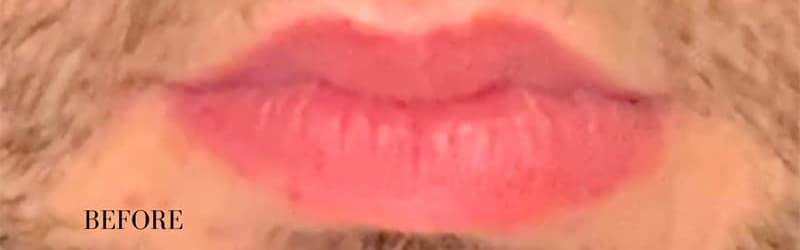Before restylane filler – lips, other view — a patient of Dr. George Ferzli, New York