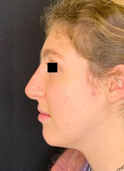 After non-surgical liquid rhinoplasty, other view — a patient of Dr. George Ferzli, New York