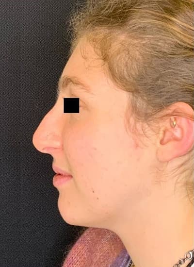 Before non-surgical liquid rhinoplasty, other view — a patient of Dr. George Ferzli, New York