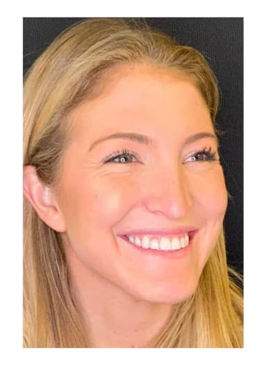 Before botox/xeomin, front view — a patient of Dr. George Ferzli, New York