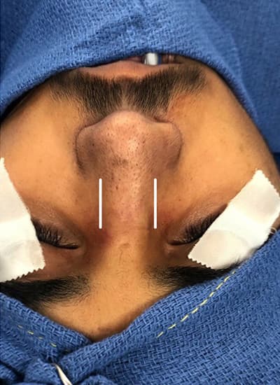 After surgical rhinoplasty, other view — a patient of Dr. George Ferzli, New York