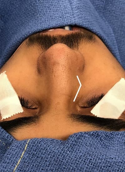 Before surgical rhinoplasty, other view — a patient of Dr. George Ferzli, New York