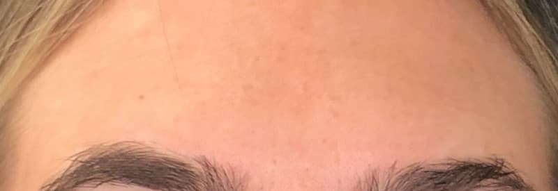 After botox / xeomin, other view — a patient of Dr. George Ferzli, New York