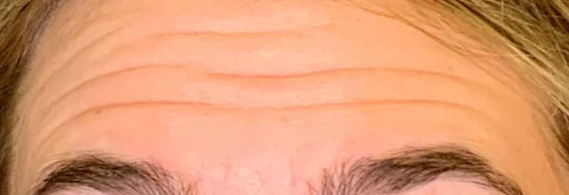 Before botox / xeomin, other view — a patient of Dr. George Ferzli, New York