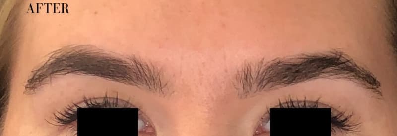 After botox / xeomin, other view — a patient of Dr. George Ferzli, New York