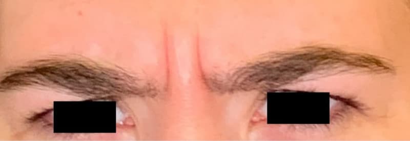 Before botox / xeomin, other view — a patient of Dr. George Ferzli, New York