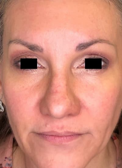 After morpheus8/microneedling, front view — a patient of Dr. George Ferzli, New York