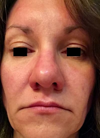Before morpheus8/microneedling, front view — a patient of Dr. George Ferzli, New York