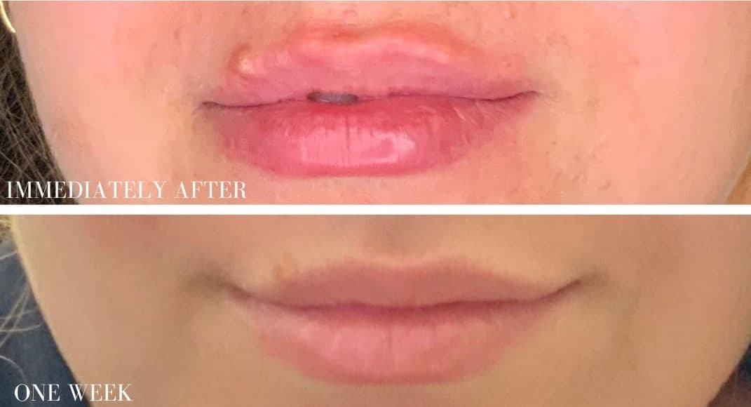 After restylane filler, front view — a patient of Dr. George Ferzli, New York
