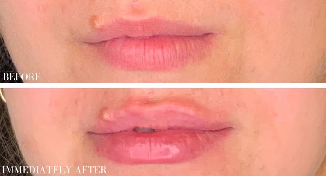 Before restylane filler, front view — a patient of Dr. George Ferzli, New York