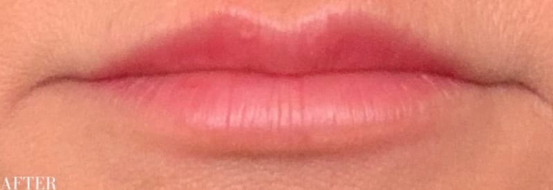 After restylane filler, other view — a patient of Dr. George Ferzli, New York