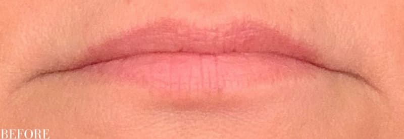 Before restylane filler, other view — a patient of Dr. George Ferzli, New York