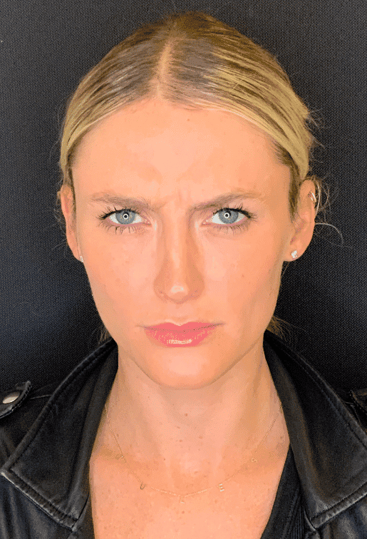 Before botox / xeomin, front view — a patient of Dr. George Ferzli, New York