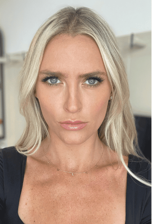 After botox / xeomin, front view — a patient of Dr. George Ferzli, New York