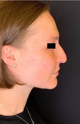 Before liquid rhinoplasty, right side view — a patient of Dr. George Ferzli, New York