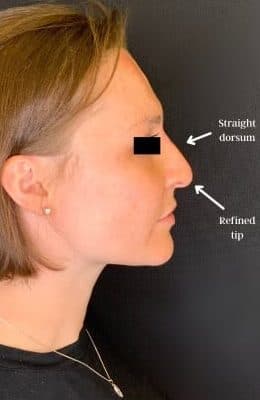 After liquid rhinoplasty, right side view — a patient of Dr. George Ferzli, New York
