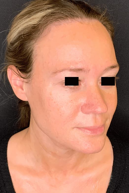 Before morpheus8/microneedling, right front oblique view — a patient of Dr. George Ferzli, New York