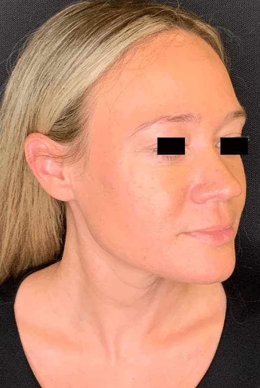 After morpheus8/microneedling, right front oblique view — a patient of Dr. George Ferzli, New York