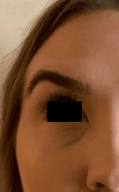 After botox / xeomin, front view — a patient of Dr. George Ferzli, New York