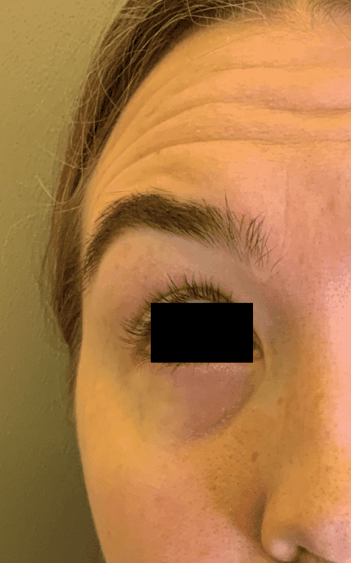 Before botox / xeomin, front view — a patient of Dr. George Ferzli, New York