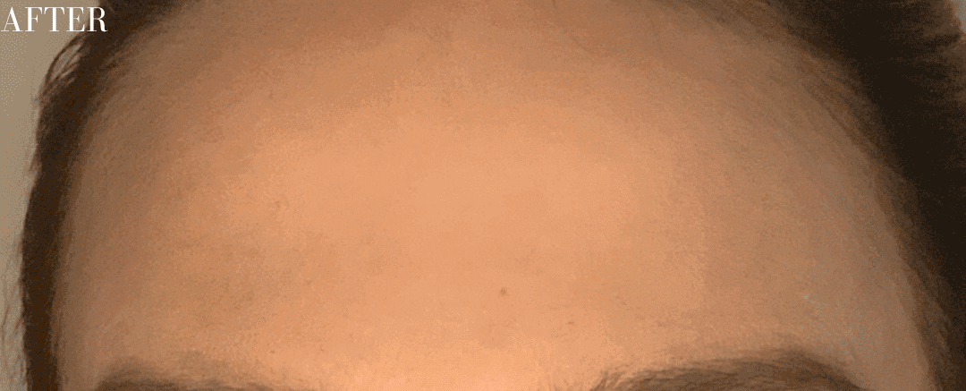 After botox / xeomin, front view — a patient of Dr. George Ferzli, New York