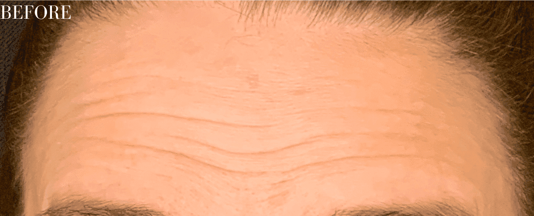 Before botox / xeomin, front view — a patient of Dr. George Ferzli, New York