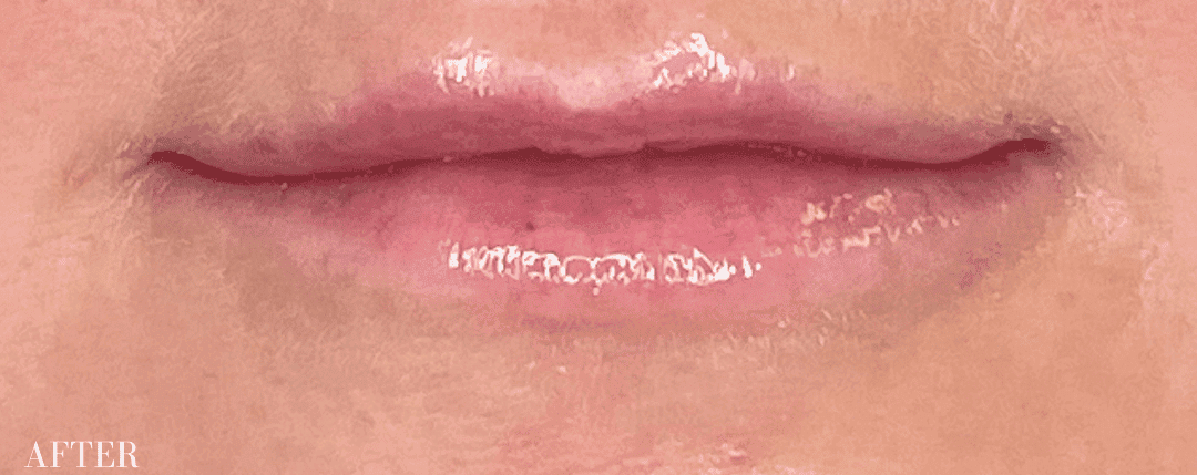 After restylane filler, front view — a patient of Dr. George Ferzli, New York