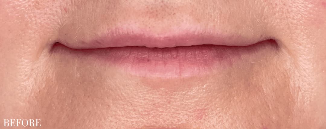 Before restylane filler, front view — a patient of Dr. George Ferzli, New York