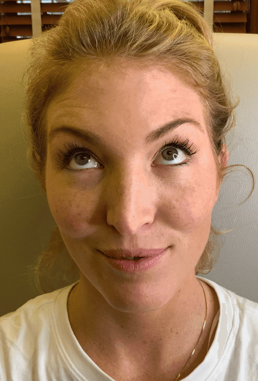Before botox / xeomin, front view — a patient of Dr. George Ferzli, New York