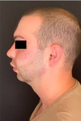 After jawline filler, left side view — a patient of Dr. George Ferzli, New York