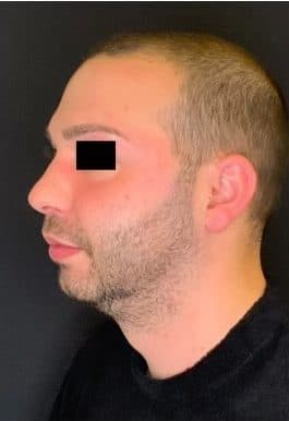 Before jawline filler, left side view — a patient of Dr. George Ferzli, New York