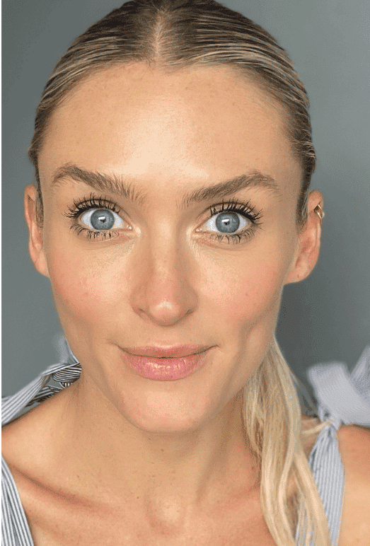After xeomin, front view — a patient of Dr. George Ferzli, New York