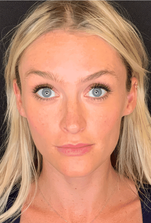 Before xeomin, front view — a patient of Dr. George Ferzli, New York