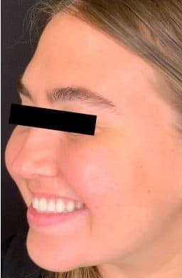After botox / xeomin, left front oblique view — a patient of Dr. George Ferzli, New York