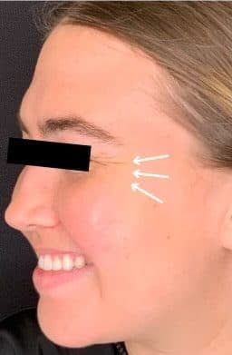 Before botox / xeomin, left front oblique view — a patient of Dr. George Ferzli, New York