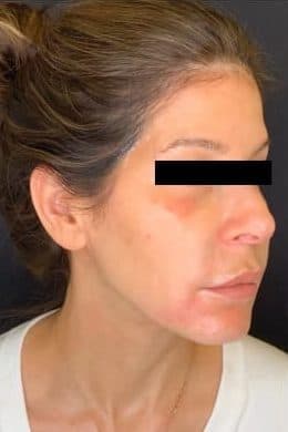Before morpheus 8, right front oblique view — a patient of Dr. George Ferzli, New York